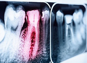 X-rays with root canal treated tooth highlighted red