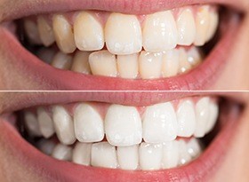 Smile before and then after teeth whitening