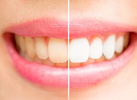 Smile split half before and half after teeth whitening