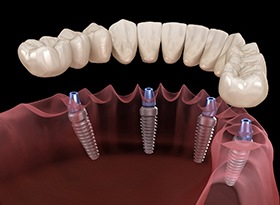 All-On-4 dental implants
