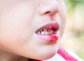A young child crying after experiencing a dental injury while outside
