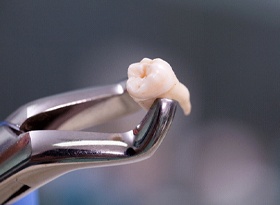 Forceps holding extracted tooth in Covina