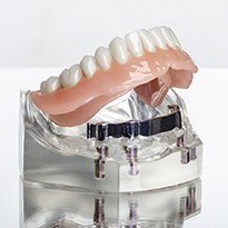 full denture being placed on top of a model of the jaw 