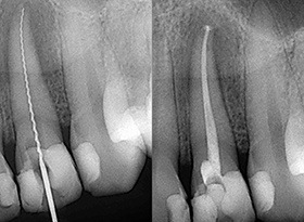 X-rays of tooth during root canal process