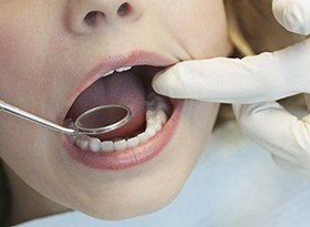 Closeup of child receiving dental sealants