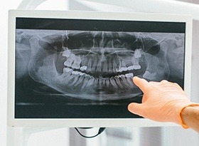 Panoramic dental x-rays on computer