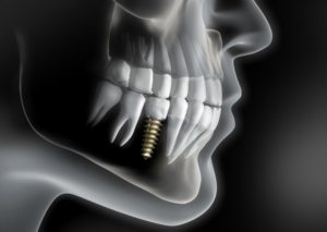 x-ray of dental implant in Covina